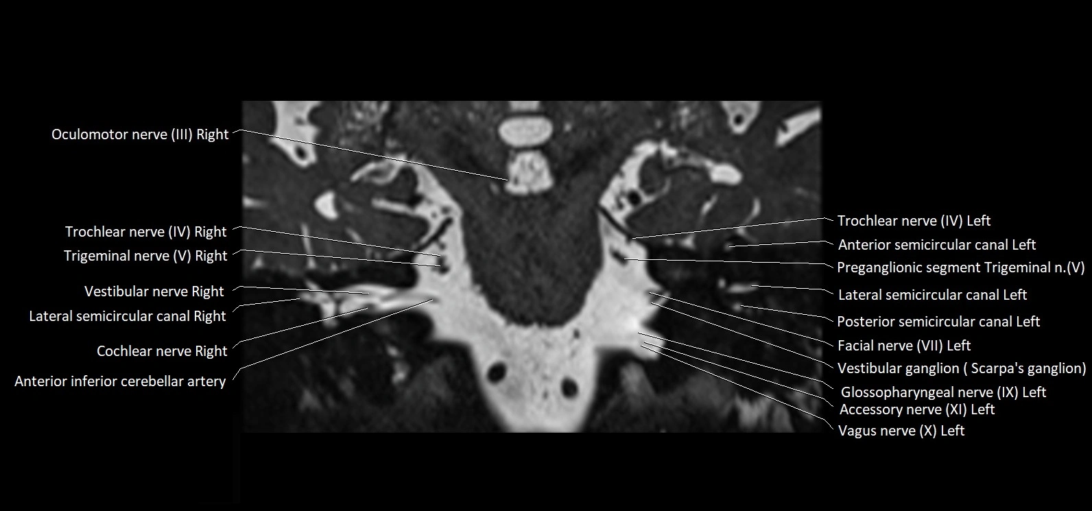 Cranial nerve cross sectional anatomy coronal 3T MRI image 41.webp
